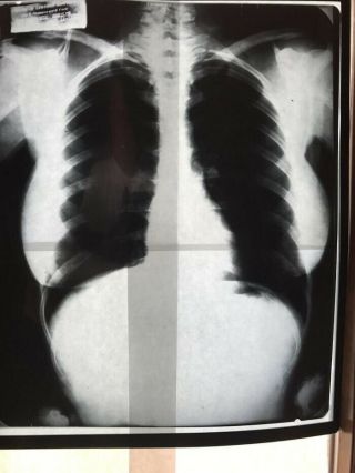 Very Rare Xray X - ray Of Marilyn Monroe’s Chest With 2