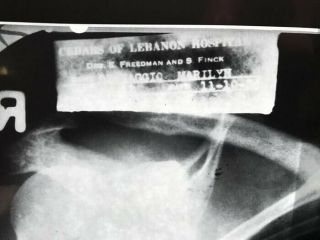 Very Rare Xray X - ray Of Marilyn Monroe’s Chest With 3