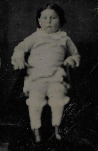 Tintype Photo T198 Chubby Faced Child W/ Tinted Cheeks & Deformed Feet Posing