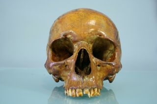 18th Antique Medical Demonstration Human Skull For Study,  Pathology,  Dentistry